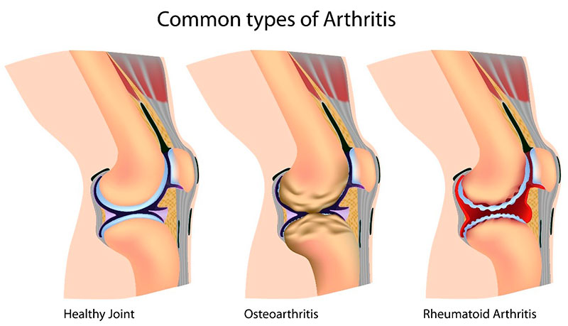 Yaygın artrit tipleri